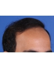 After Hair Transplant&nbsp;Front